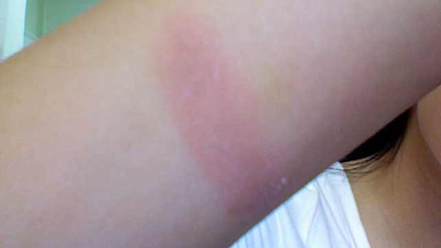 burn on arm