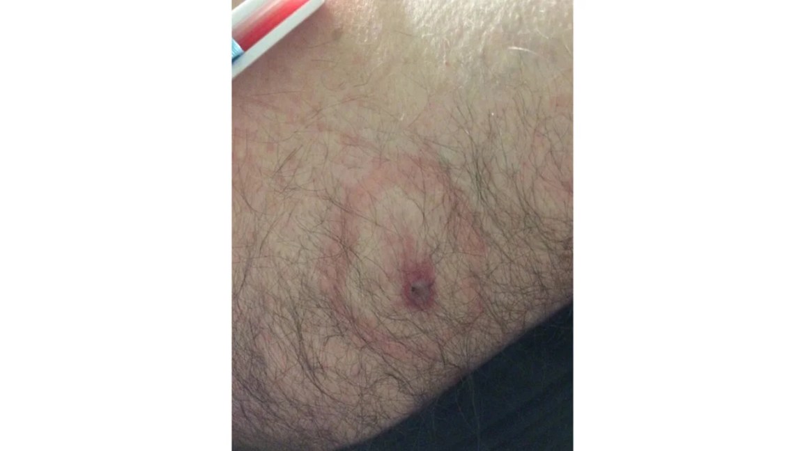 black widow spider bite