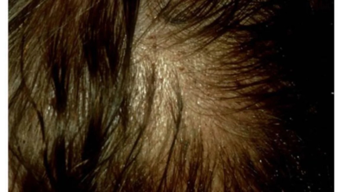 lice bites on head
