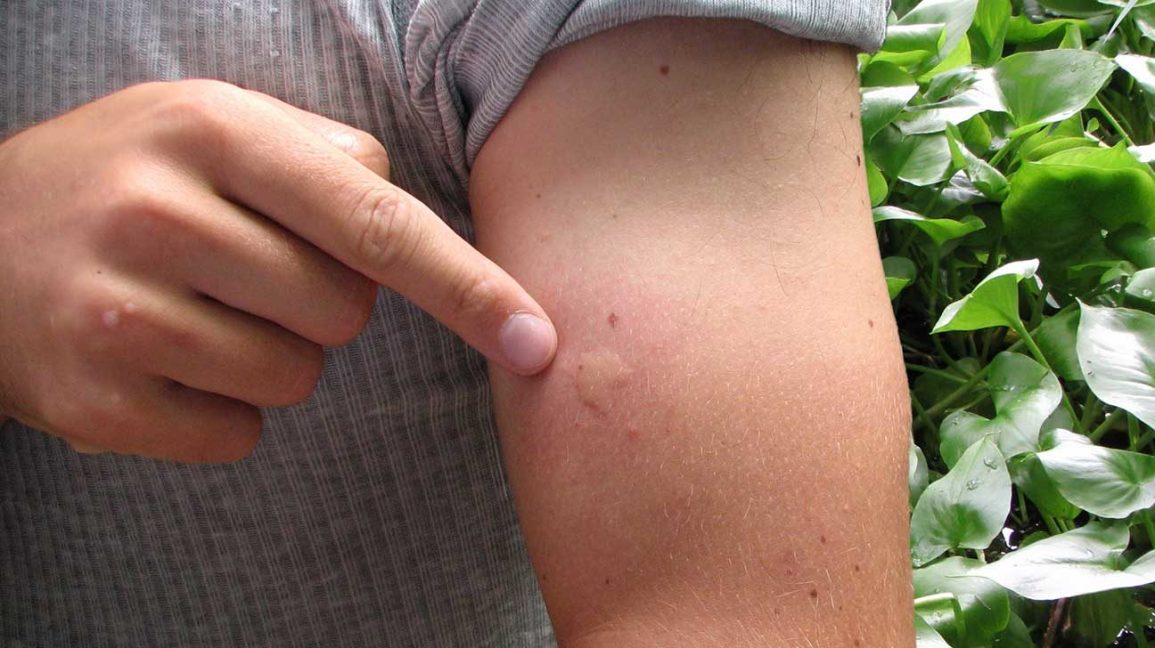 A mosquito bite is a small, round, puffy bump