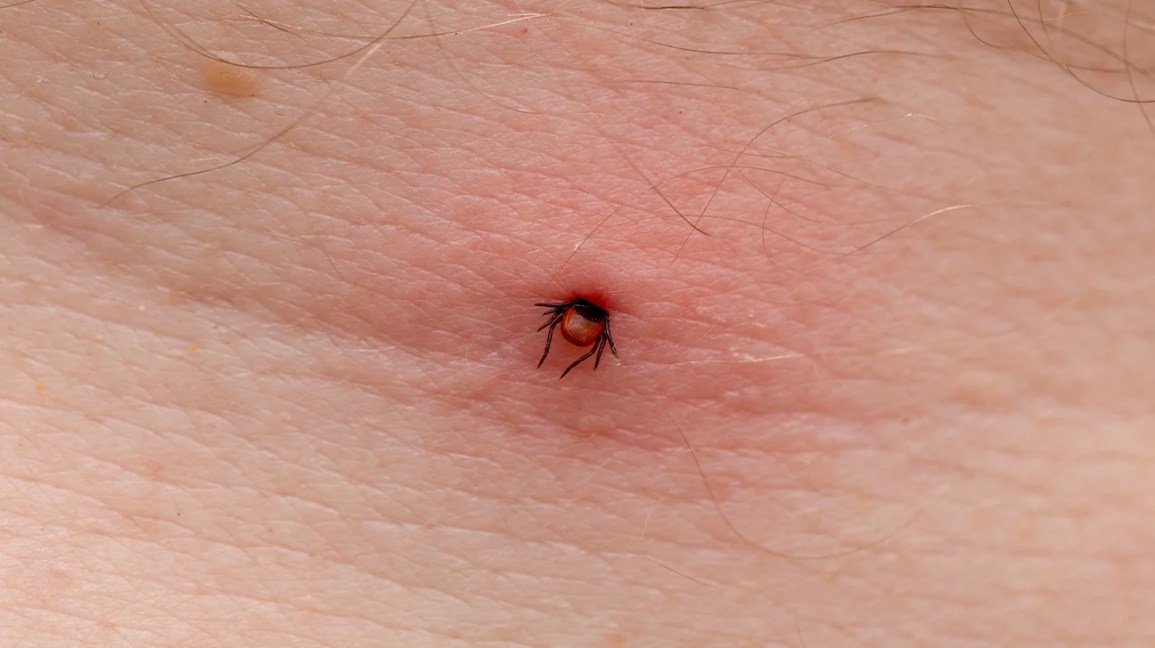 tick biting into skin