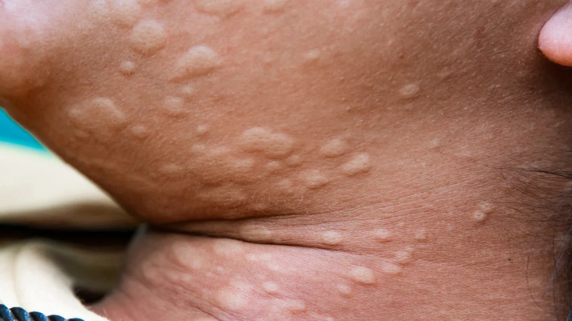Hives on skin